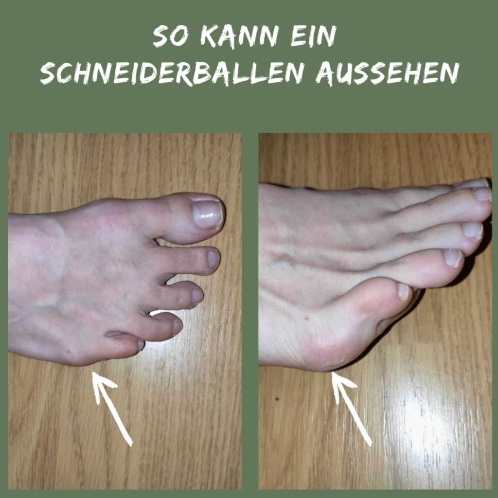 Aussehen eines Schneiderballens