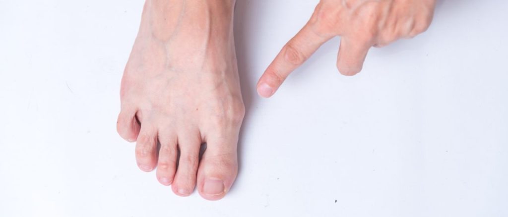 Mythos Hallux valgus