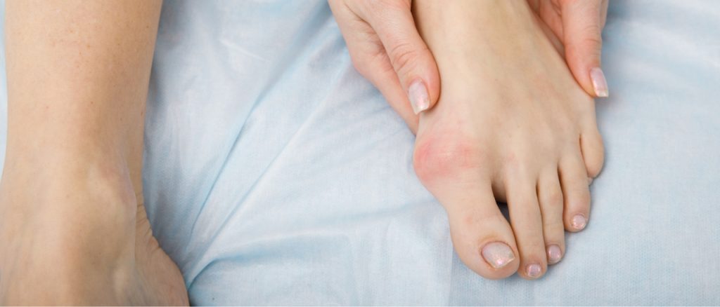 Linker Frauenfuß mit Hallux valgus, gerötet, schmerzhaft