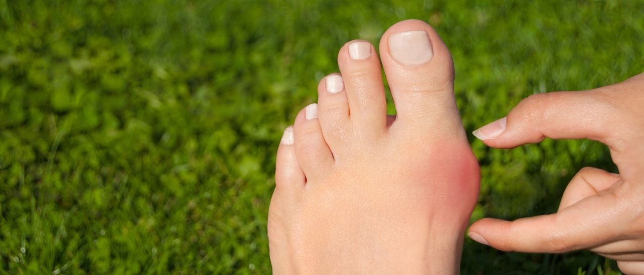 Hallux valgus: Ursachen, Symptome und was du wirklich dagegen tun kannst, wenn der große Zeh die Kurve kratzt