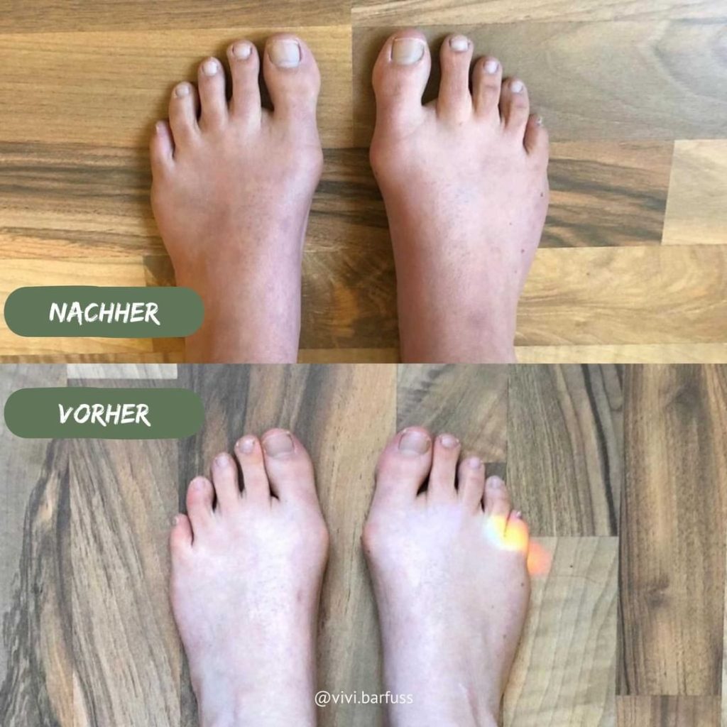 Hallux valgus Vorher Nachher 1
