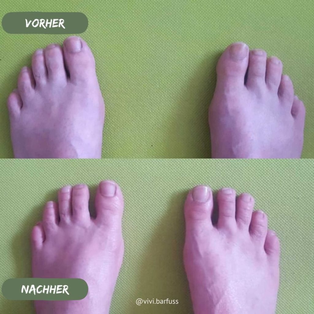 Hallux valgus Vorher Nachher 2