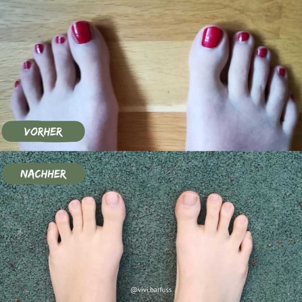 Hallux valgus Vorher Nachher 3