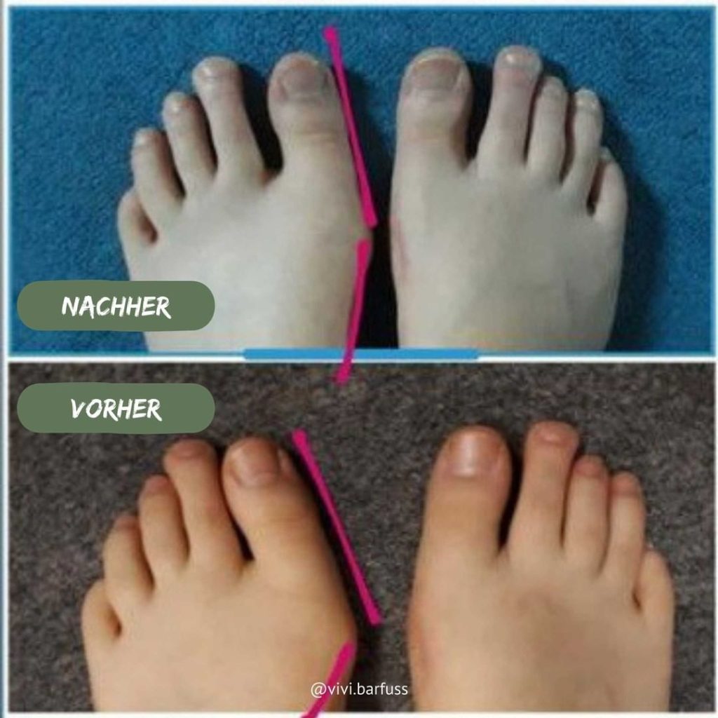 Hallux valgus Vorher Nachher 4
