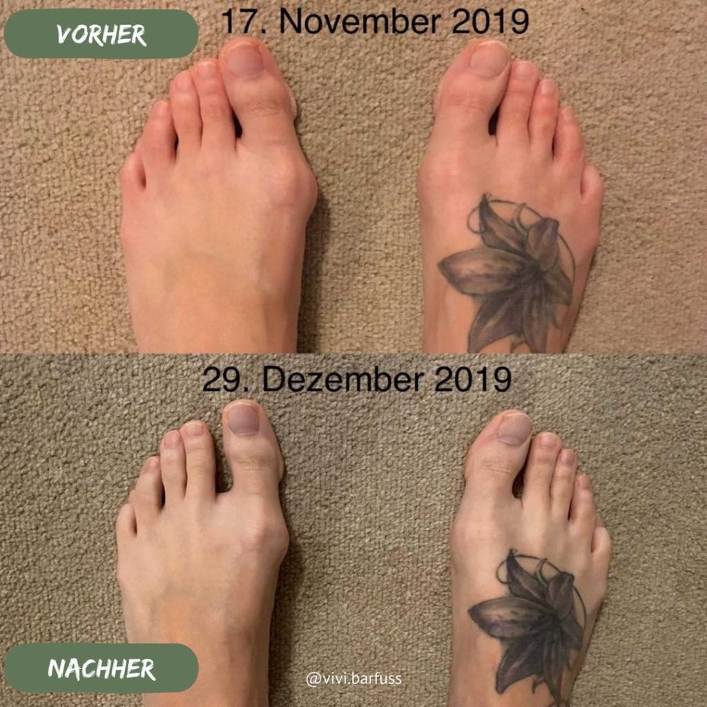 Hallux valgus Vorher Nachher 5