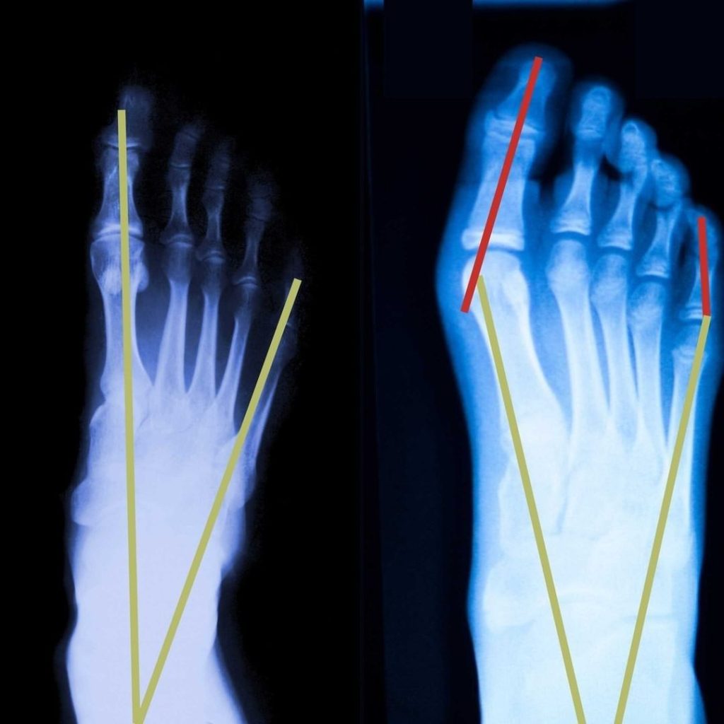Röntgenbild Vergleich Hallux valgus und gesunder Fuß