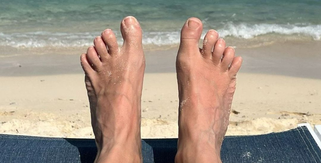Hallux rigidus
