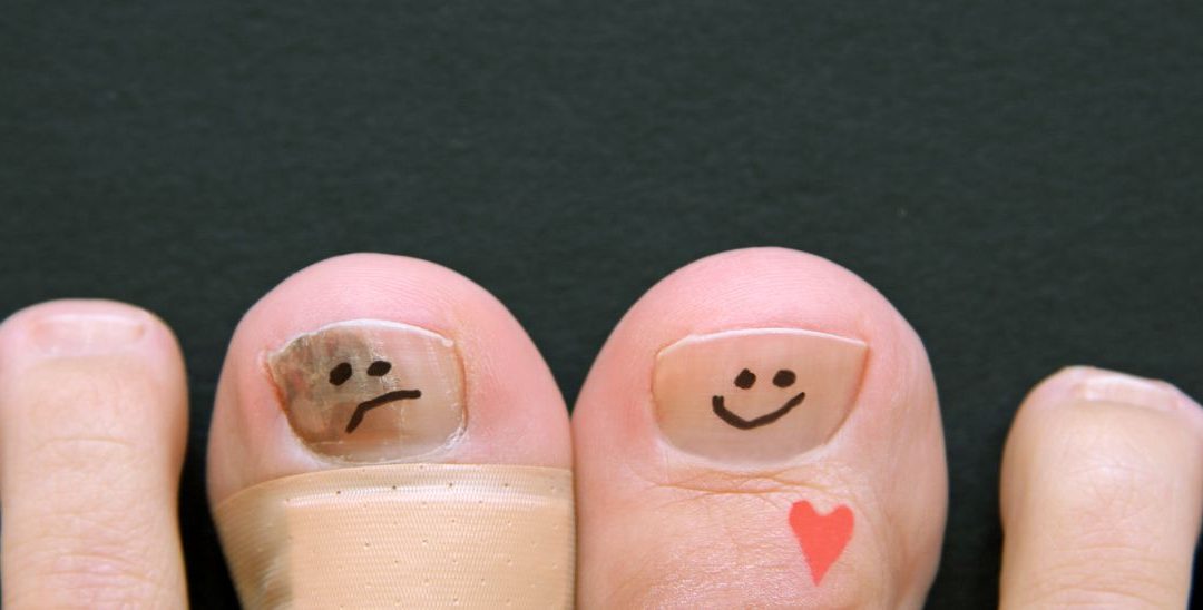 Ich habe einen Hallux limitus: wie hilft funktionelle Fußtherapie einen Hallux rigidus zu verhindern?