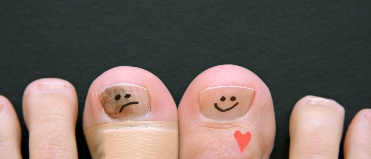 Ich habe einen Hallux limitus: wie hilft funktionelle Fußtherapie einen Hallux rigidus zu verhindern?