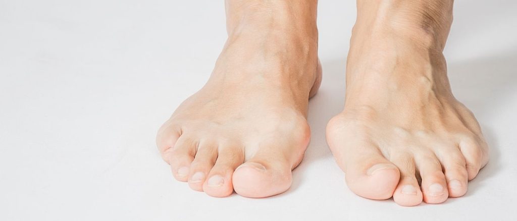 Vivian Glaesel Hallux valgus bei Maennern