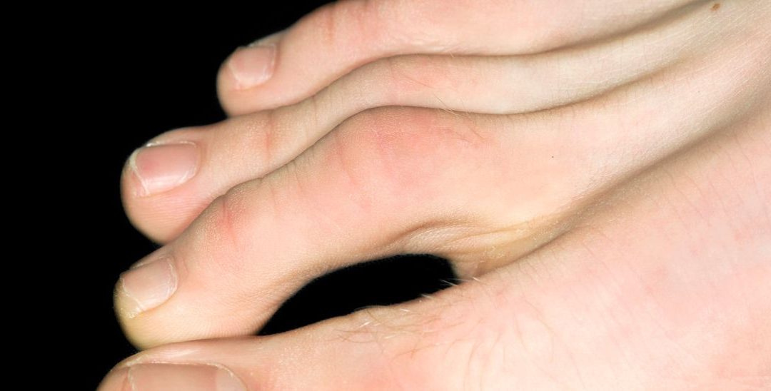 Hammer-, Mallet- und Krallenzehen: Einblicke in die Welt der Zehenverformungen inkl. 3 Übungen