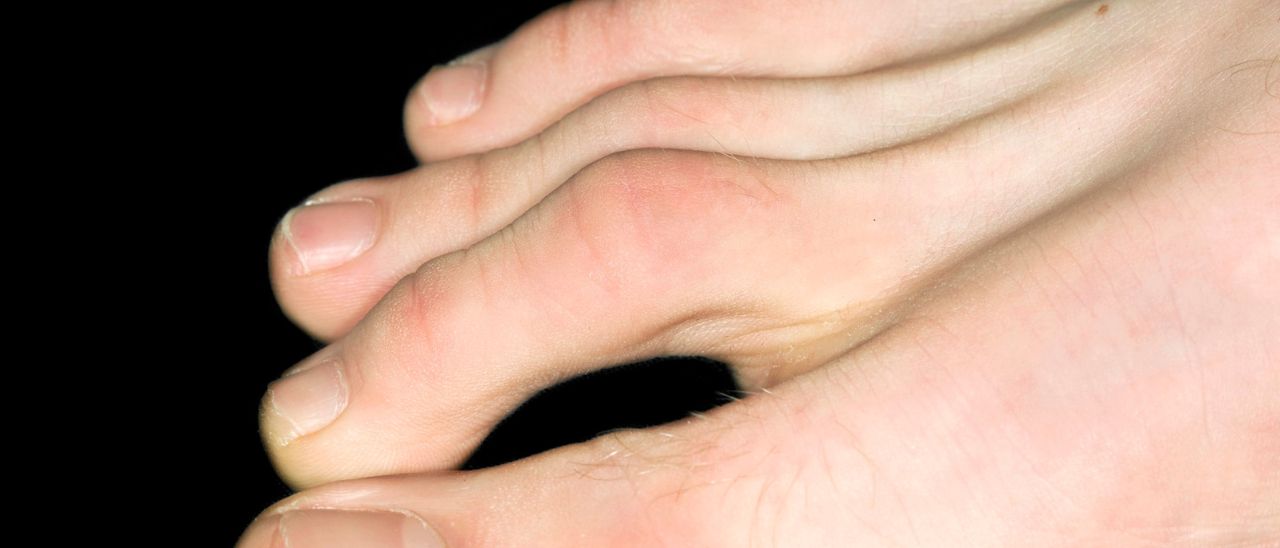 Hammer-, Mallet- und Krallenzehen: Einblicke in die Welt der Zehenverformungen inkl. 3 Übungen