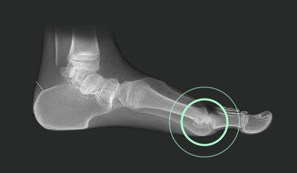 Hallux rigidus Röntgenaufnahme