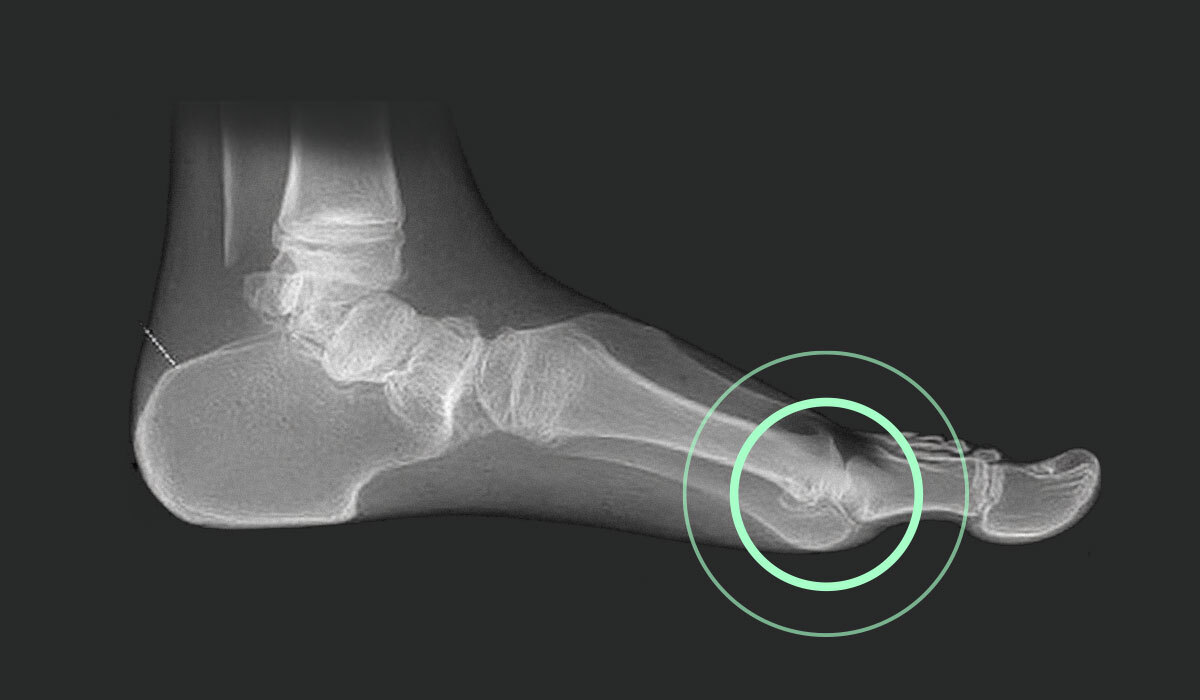 Hallux rigidus Röntgenaufnahme