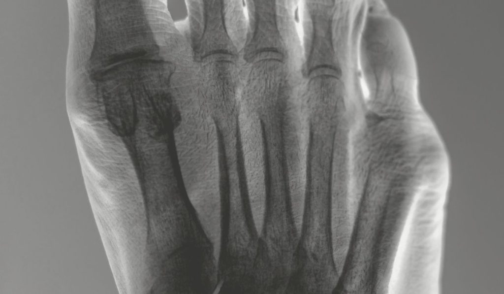 Keyvisual Metatarsalgie 1200 x 700