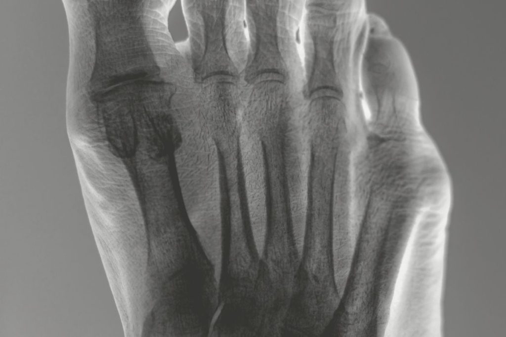 Keyvisual Metatarsalgie 1200 x 800 px