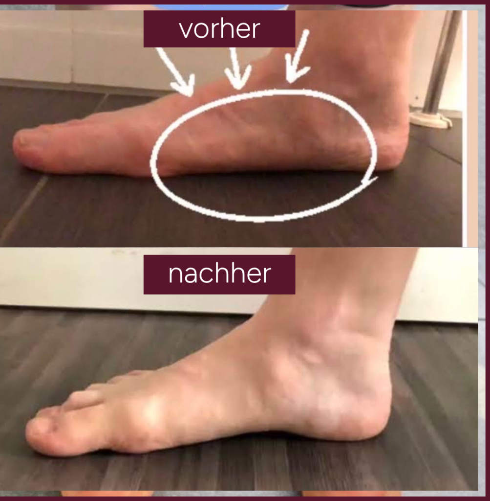 Knick-SenkfußPlattfuß Vorher-Nachher(2) Knick SenkfussPlattfuss Vorher Nachher2