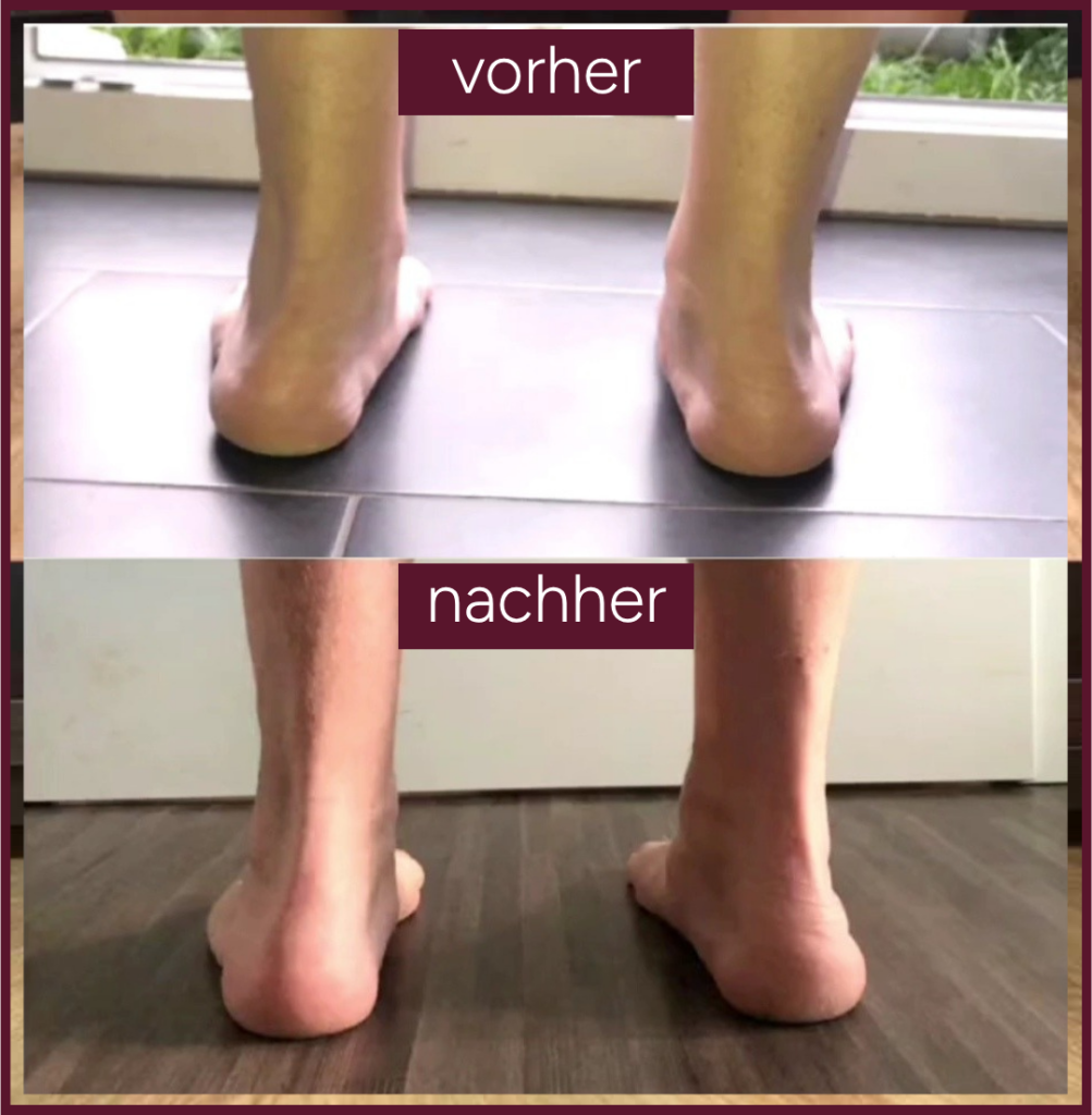 Knick SenkfussPlattfuss Vorher Nachher3
