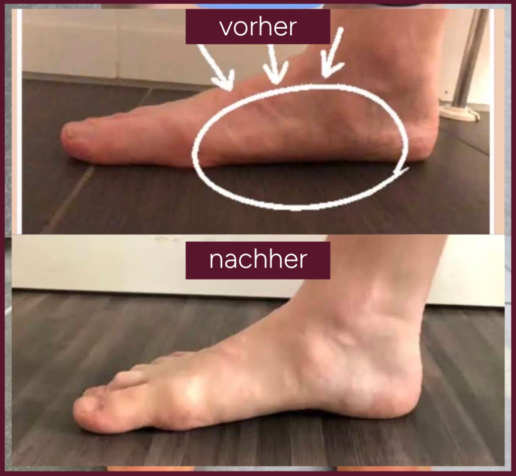 Knick SenkfussPlattfuss Vorher Nachher4