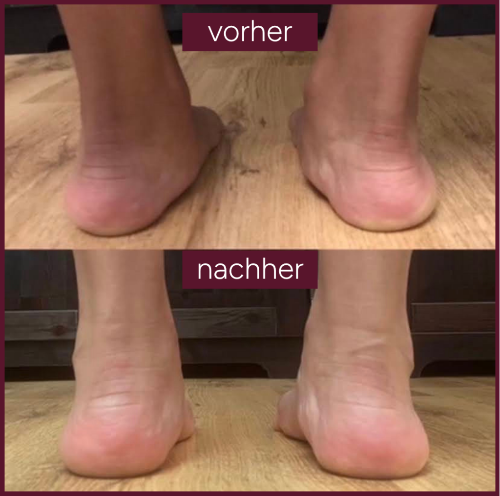 Knick SenkfussPlattfuss Vorher Nachher5